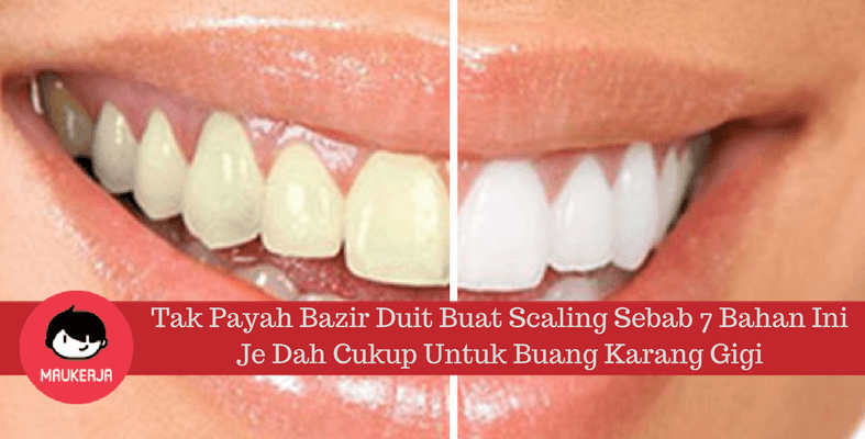 Tak Payah Bazir Duit Buat Scaling Sebab 7 Bahan Ini Je Dah Cukup Untuk Buang Karang Gigi